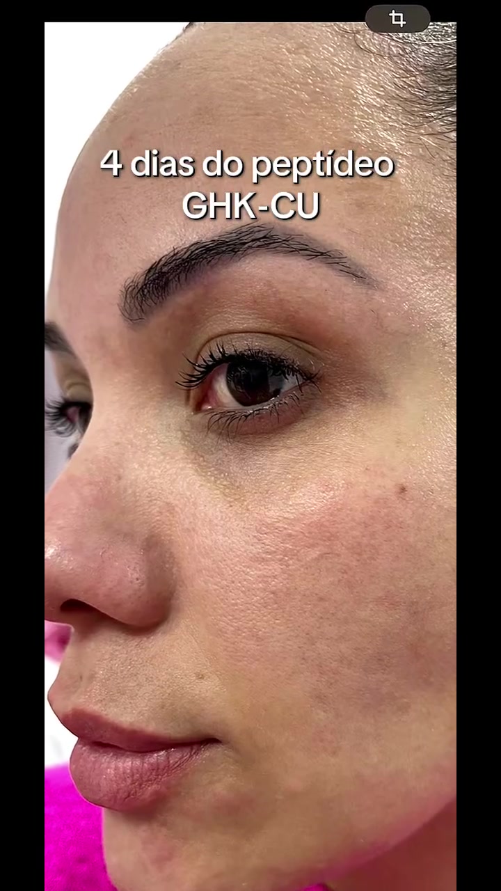 4 dias de GHK-CU peptideo da beleza , e o resultado mais evidente até...